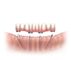 Orlando dental implants