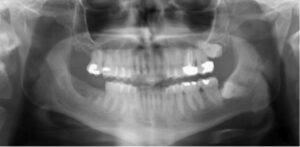 Orlando wisdom teeth extractions