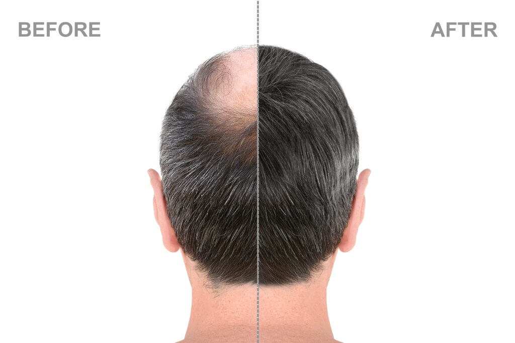 Male Pattern Baldness Restoration with Platelet Rich Plasma Treatment