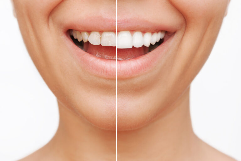 teeth whitening before and after