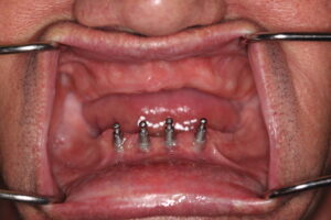 Orlando Dental Implants