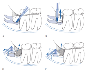 Sideways wisdom tooth