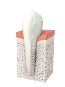 Clermont dental implants