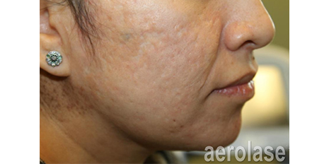 acne treatment in Orlando Florida