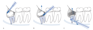 Wisdom teeth backwards