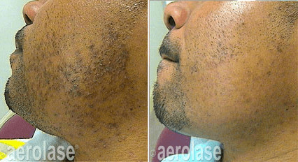 Ingrown Hair Treatment Before and After Photos