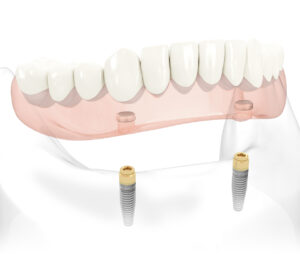 Orlando dental implants