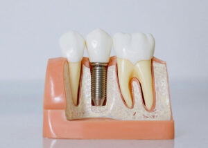 dental implants