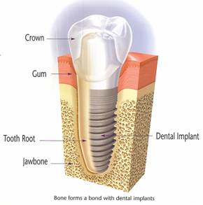 Lake Nona Dental Implant