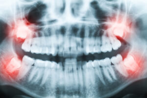 wisdom teeth extractions orlando