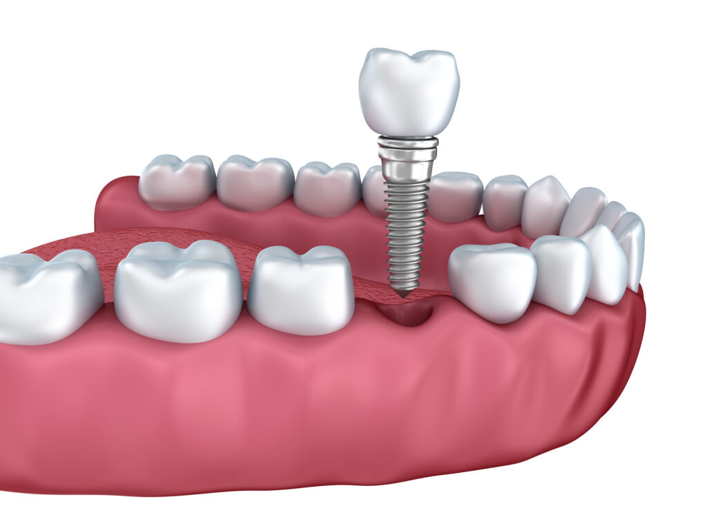 dental implants orlando