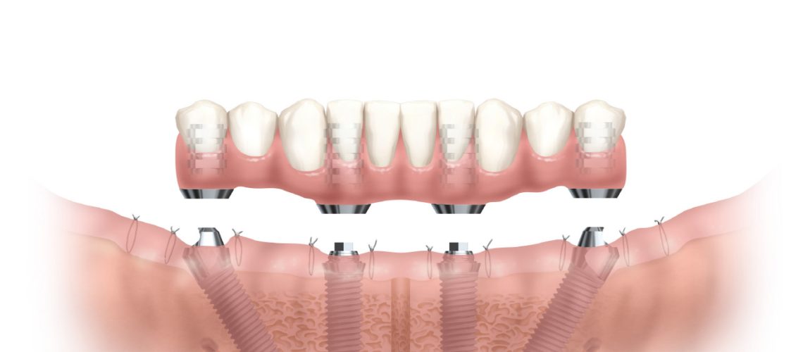 Orlando dental implants