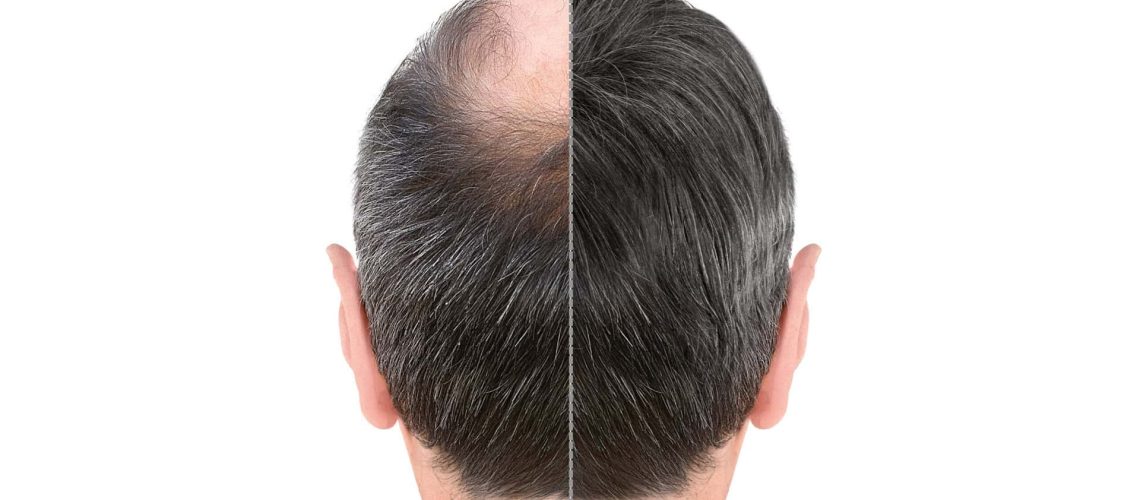 Male Pattern Baldness Restoration with Platelet Rich Plasma Treatment