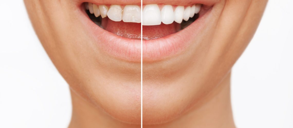 teeth whitening before and after