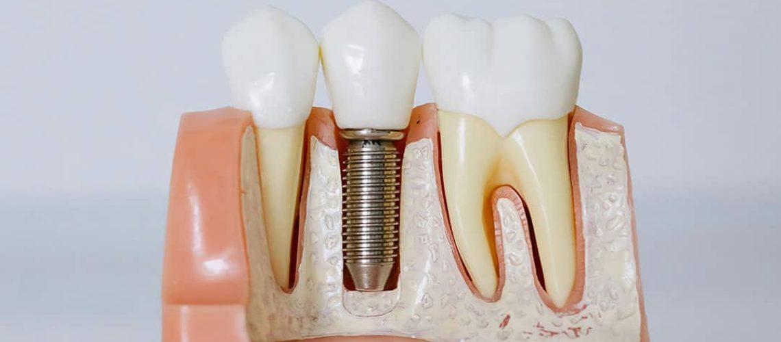 dental implants