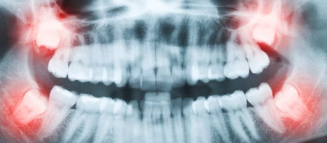 wisdom teeth extractions orlando