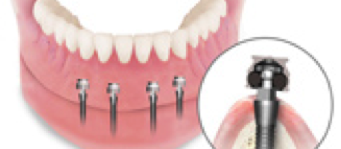 Lake Nona dental implants