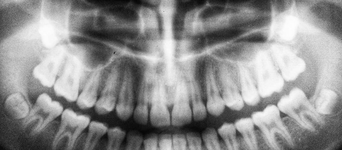 wisdom tooth extraction xray