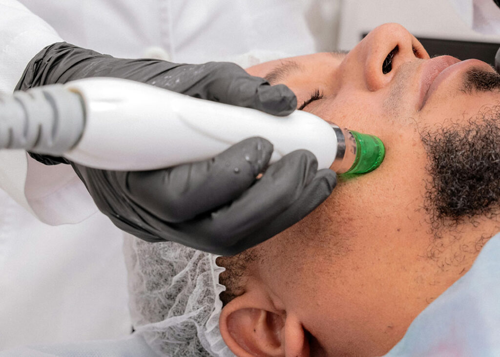 microneedling treatment for ingrown hair