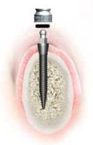 Orlando Dental Implants