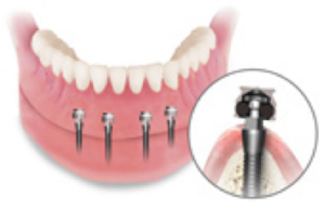 Lake Nona dental implants