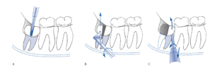 Tilted wisdom teeth