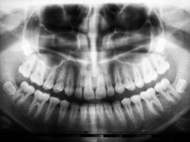 wisdom tooth extraction xray